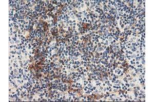 Immunohistochemical staining of paraffin-embedded Human lymphoma tissue using anti-NAPEPLD mouse monoclonal antibody. (NAPEPLD anticorps)