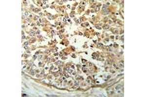 STING antibody IHC analysis in formalin fixed and paraffin embedded breast carcinoma.
