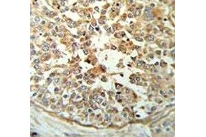 STING antibody IHC analysis in formalin fixed and paraffin embedded breast carcinoma. (STING/TMEM173 anticorps  (AA 311-340))