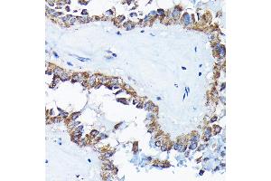 Immunohistochemistry of paraffin-embedded human thyroid cancer using ETFA Rabbit pAb  at dilution of 1:200 (40x lens). (ETFA anticorps  (AA 1-333))