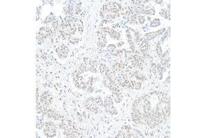 Immunohistochemistry (IHC) image for anti-SWI/SNF Related, Matrix Associated, Actin Dependent Regulator of Chromatin, Subfamily A, Member 4 (SMARCA4) (AA 75-125) antibody (ABIN7454677)