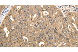 Immunohistochemistry of paraffin-embedded Human ovarian cancer using STX1A Polyclonal Antibody at dilution of 1:40