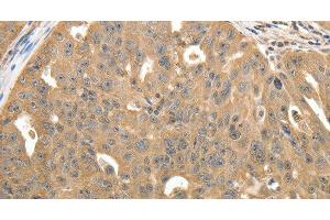Immunohistochemistry of paraffin-embedded Human ovarian cancer using STX1A Polyclonal Antibody at dilution of 1:40 (STX1A anticorps)