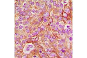 Immunohistochemical analysis of GABRB1 (pS434) staining in human breast cancer formalin fixed paraffin embedded tissue section. (GABRB1 anticorps  (C-Term, pSer434))
