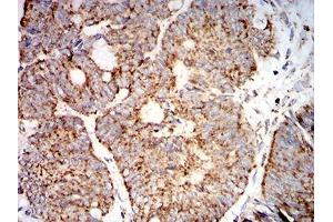 Immunohistochemical analysis of paraffin-embedded rectum cancer tissues using SOD2 mouse mAb with DAB staining.