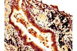 IHC image of ABIN7172615 diluted at 1:500 and staining in paraffin-embedded human lung cancer performed on a Leica BondTM system.