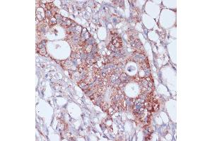 Immunohistochemistry of paraffin-embedded human colon carcinoma using MRPL23 antibody (ABIN7268564) at dilution of 1:100 (40x lens). (MRPL23 anticorps  (AA 1-153))