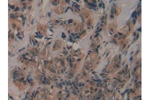 DAB staining on IHC-P; Samples: Human Breast cancer Tissue (Fibrillin 2 anticorps  (AA 1550-1791))