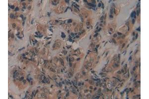 DAB staining on IHC-P; Samples: Human Breast cancer Tissue