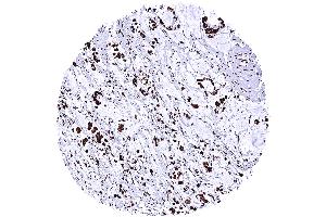 Gastric adenocarcinoma diffuse type with intense nuclear TRIM28 immunostaining of tumor cells (Recombinant KAP1 anticorps  (Center))