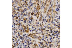 Immunohistochemistry of paraffin-embedded human lung cancer using MMP25 antibody (ABIN5971552) at dilution of 1/200 (40x lens). (MMP25 anticorps)