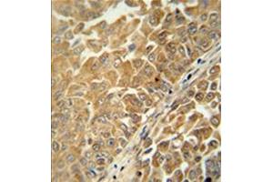Formalin fixed, paraffin embedded human bladder carcinoma stained with C18orf25 Antibody  followed by peroxidase conjugation of the secondary antibody and DAB staining. (C18ORF25 anticorps  (Middle Region))
