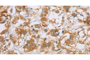 Immunohistochemistry of paraffin-embedded Human thyroid cancer using CYP2E1 Polyclonal Antibody at dilution of 1:35 (CYP2E1 anticorps)