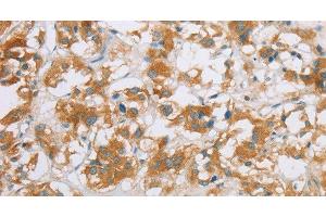 Immunohistochemistry of paraffin-embedded Human thyroid cancer using CYP2E1 Polyclonal Antibody at dilution of 1:35