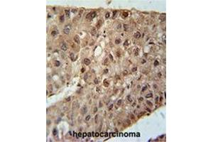 ZC4H2 Antibody (C-term) immunohistochemistry analysis in formalin fixed and paraffin embedded human hepatocarcinoma followed by peroxidase conjugation of the secondary antibody and DAB staining. (ZC4H2 anticorps  (C-Term))