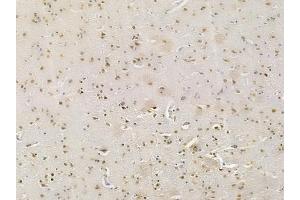 ABIN6262423 and ABIN6277569 at 1/100 staining human glioblastoma by IHC-P.