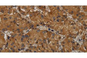 Immunohistochemistry of paraffin-embedded Human liver cancer tissue using MAS1 Polyclonal Antibody at dilution 1:50 (MAS1 anticorps)
