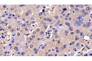 Detection of CASP10 in Human Liver cancer Tissue using Polyclonal Antibody to Caspase 10 (CASP10)