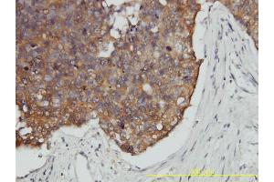Immunoperoxidase of monoclonal antibody to VBP1 on formalin-fixed paraffin-embedded human breast cancer tissue.