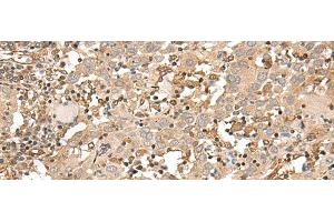 Immunohistochemistry of paraffin-embedded Human cervical cancer tissue using FSTL5 Polyclonal Antibody at dilution of 1:50(x200) (FSTL5 anticorps)