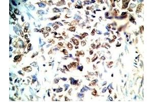 Human lung cancer tissue stained by Rabbit Anti-CRAMP(140-173) (Mouse) Antibody