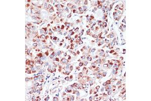 Immunohistochemistry of paraffin-embedded human liver cancer using CD71/Transferrin Receptor antibody (ABIN6131555, ABIN6149065, ABIN6149066 and ABIN6221572) at dilution of 1:100 (40x lens).