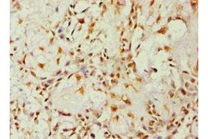 Immunohistochemistry of paraffin-embedded human breast cancer using ABIN7143676 at dilution of 1:100 (ALDH1B1 anticorps  (AA 278-517))