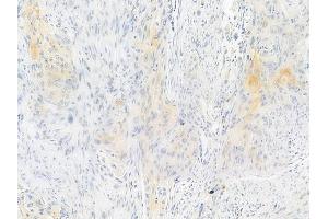 ABIN6255953 and ABIN6267550 at 1/100 staining human tongue carcinoma by IHC-P.