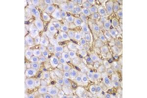 Immunohistochemistry of paraffin-embedded human liver injury using HLA-A antibody at dilution of 1:100 (400x lens).