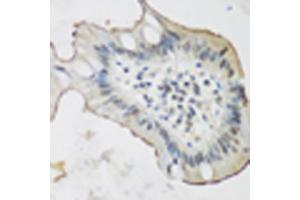 Immunohistochemistry of paraffin-embedded human stomach cancer using ALOX15 antibody (ABIN5975430) at dilution of 1/200 (40x lens). (ALOX15 anticorps)