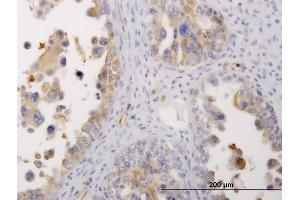 Immunoperoxidase of monoclonal antibody to MYH9 on formalin-fixed paraffin-embedded human ovarian cancer.