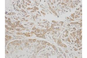 IHC-P Image Immunohistochemical analysis of paraffin-embedded A549 xenograft, using C1 inhibitor, antibody at 1:300 dilution. (SERPING1 anticorps  (Center))