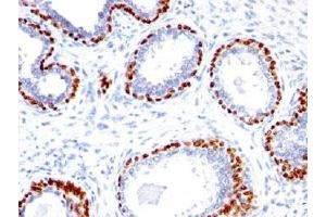 IHC testing of FFPE human prostate cancer with p40 antibody. (p40 (p63 Delta) (AA 5-17) anticorps)