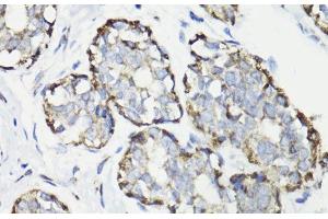 Immunohistochemistry of paraffin-embedded Human breast cancer using WASF3 Polyclonal Antibody at dilution of 1:100 (40x lens). (WASF3 anticorps)