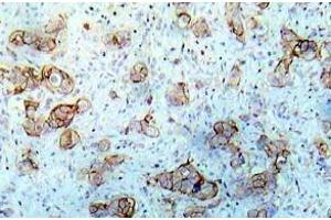 Immunohistochemistry (IHC) analyzes of EGFR pAb in paraffin-embedded human breast carcinoma tissue. (EGFR anticorps)