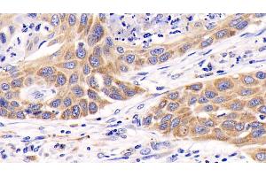 Detection of ERK1 in Human Lung cancer Tissue using Monoclonal Antibody to Extracellular Signal Regulated Kinase 1 (ERK1)