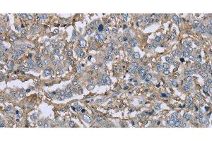 Immunohistochemistry of paraffin-embedded Human liver cancer using CD32 Polyclonal Antibody at dilution of 1:40 (Fc gamma RII (CD32) anticorps)