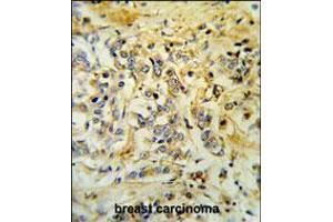 LMBR1L Antibody IHC analysis in formalin fixed and paraffin embedded breast carcinoma followed by peroxidase conjugation of the secondary antibody and DAB staining.