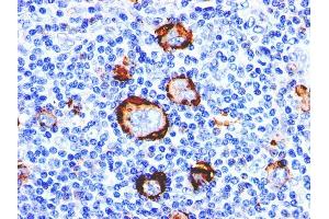 Formalin-fixed, paraffin-embedded human Hodgkin's Lymphoma stained with CD15 Monoclonal Antibody (Leu-M1).