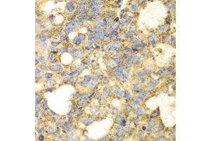 Immunohistochemistry of paraffin-embedded human oophoroma using SOD2 antibody.