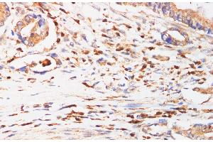 Immunohistochemistry of paraffin-embedded Human Duodenum cancer using IFNAR1 Polyclonl Antibody at dilution of 1:200. (IFNAR1 anticorps)