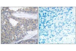 Immunohistochemical analysis of paraffin-embedded human breast carcinoma tissue using Paxillin (Ab-31) antibody (E021199). (Paxillin anticorps)