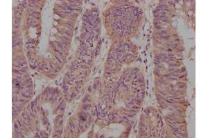 IHC image of ABIN7147174 diluted at 1:500 and staining in paraffin-embedded human lung cancer tissue performed on a Leica BondTM system.