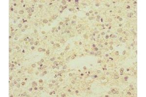 Immunohistochemistry of paraffin-embedded human glioma using ABIN7143097 at dilution of 1:100 (ARPC5 anticorps  (AA 1-154))