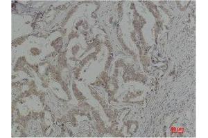 Immunohistochemistry (IHC) analysis of paraffin-embedded Human Breast Carcinoma using Caspase-8 Polyclonal Antibody.