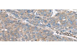 Immunohistochemistry of paraffin-embedded Human liver cancer tissue using GULP1 Polyclonal Antibody at dilution of 1:65(x200) (GULP1 anticorps)