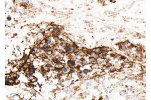 ABIN6268654 at 1/100 staining human liver carcinoma sections by IHC-P.