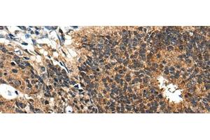 Immunohistochemistry of paraffin-embedded Human colorectal cancer tissue using BMPER Polyclonal Antibody at dilution of 1:40(x200) (BMPER anticorps)