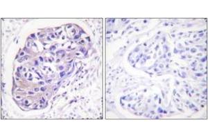 Immunohistochemistry analysis of paraffin-embedded human breast carcinoma tissue, using GRK2 (Ab-29) Antibody. (GRK2 anticorps  (AA 14-63))