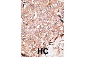 Formalin-fixed and paraffin-embedded human hepatocellular carcinoma tissue reacted with AOF2 polyclonal antibody , which was peroxidase-conjugated to the secondary antibody, followed by DAB staining. (LSD1 anticorps  (C-Term))